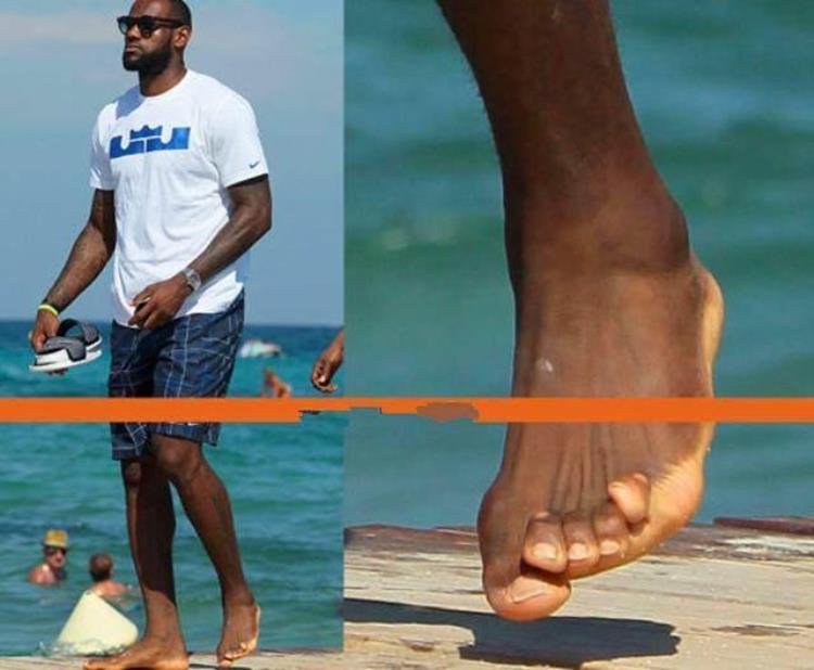科比 手指「7图看NBA打球多不容易科比手指无法弯曲詹皇哈登脚趾严重变形」