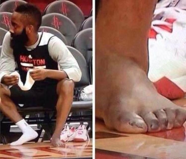 科比 手指「7图看NBA打球多不容易科比手指无法弯曲詹皇哈登脚趾严重变形」